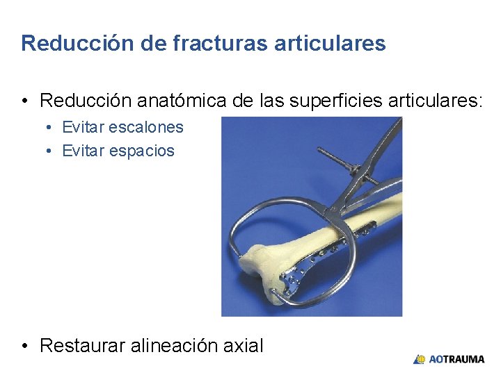 Reducción de fracturas articulares • Reducción anatómica de las superficies articulares: • Evitar escalones
