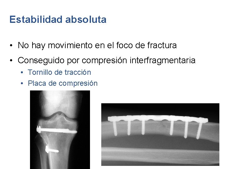 Estabilidad absoluta • No hay movimiento en el foco de fractura • Conseguido por