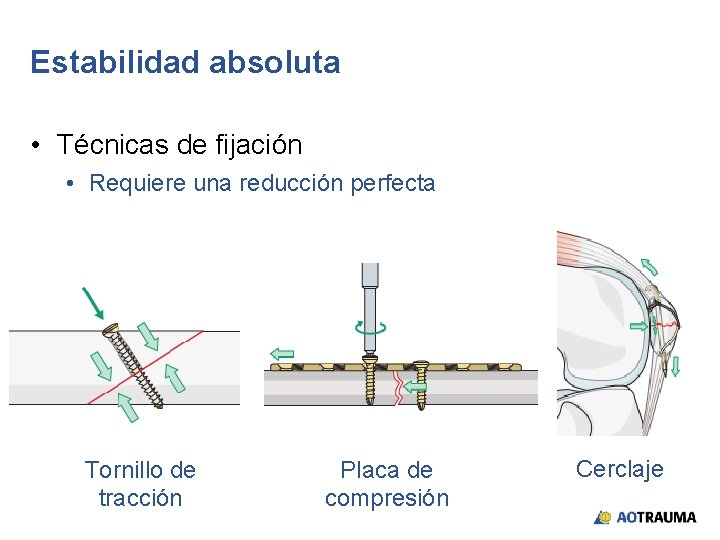 Estabilidad absoluta • Técnicas de fijación • Requiere una reducción perfecta Tornillo de tracción