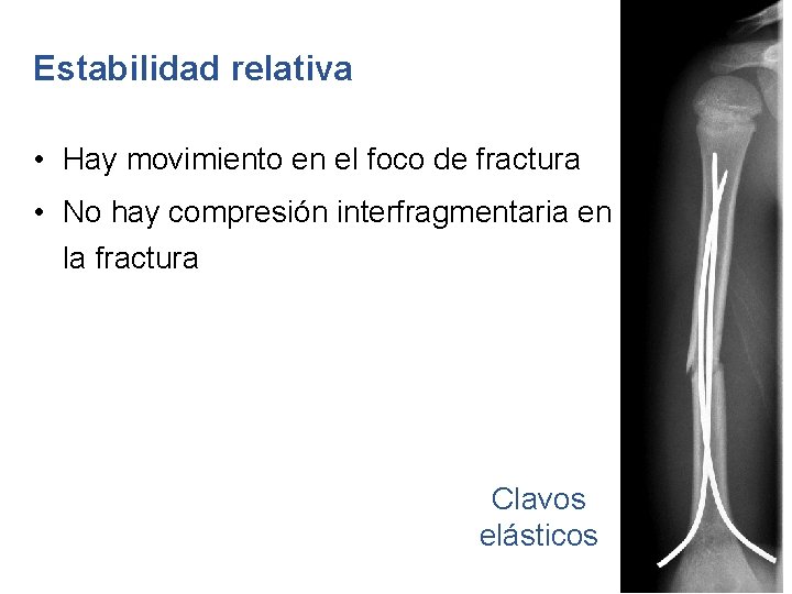 Estabilidad relativa • Hay movimiento en el foco de fractura • No hay compresión