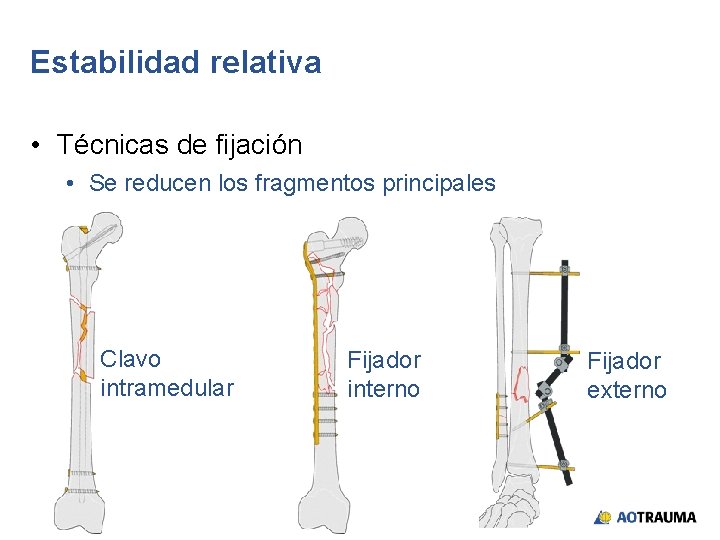 Estabilidad relativa • Técnicas de fijación • Se reducen los fragmentos principales Clavo intramedular