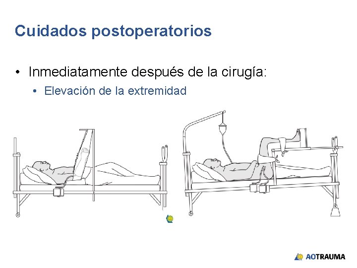 Cuidados postoperatorios • Inmediatamente después de la cirugía: • Elevación de la extremidad 