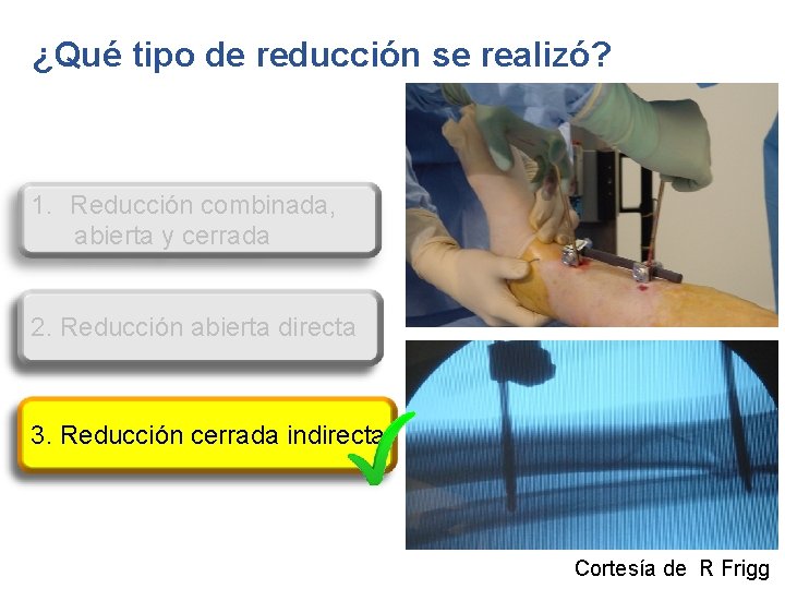 ¿Qué tipo de reducción se realizó? 1. Reducción combinada, abierta y cerrada 2. Reducción