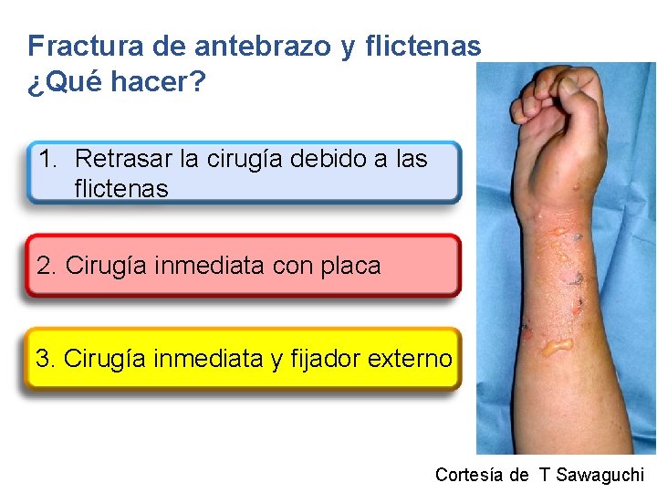 Fractura de antebrazo y flictenas ¿Qué hacer? 1. Retrasar la cirugía debido a las