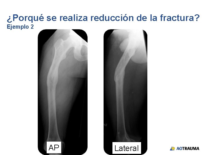 ¿Porqué se realiza reducción de la fractura? Ejemplo 2 AP Lateral 