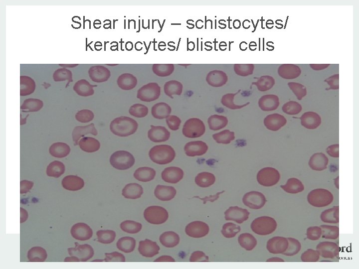 Shear injury – schistocytes/ keratocytes/ blister cells v | www. langfordvets. co. uk |