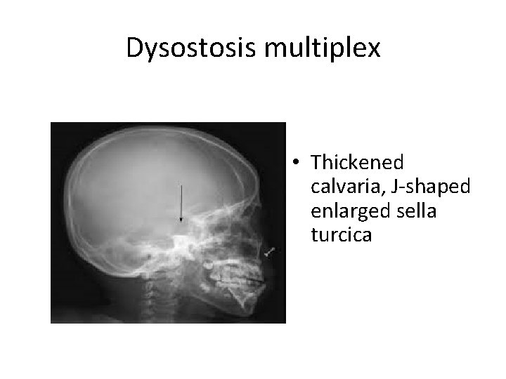 Dysostosis multiplex • Thickened calvaria, J-shaped enlarged sella turcica 