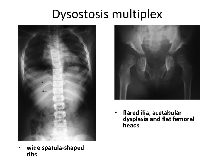 Dysostosis multiplex • flared ilia, acetabular dysplasia and flat femoral heads • wide spatula-shaped