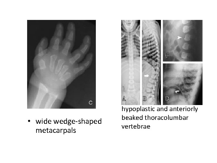  • wide wedge-shaped metacarpals hypoplastic and anteriorly beaked thoracolumbar vertebrae 