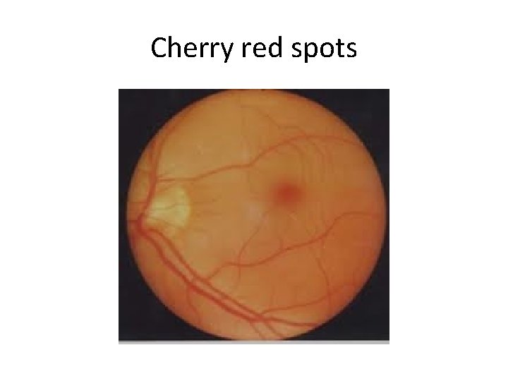 Cherry red spots 