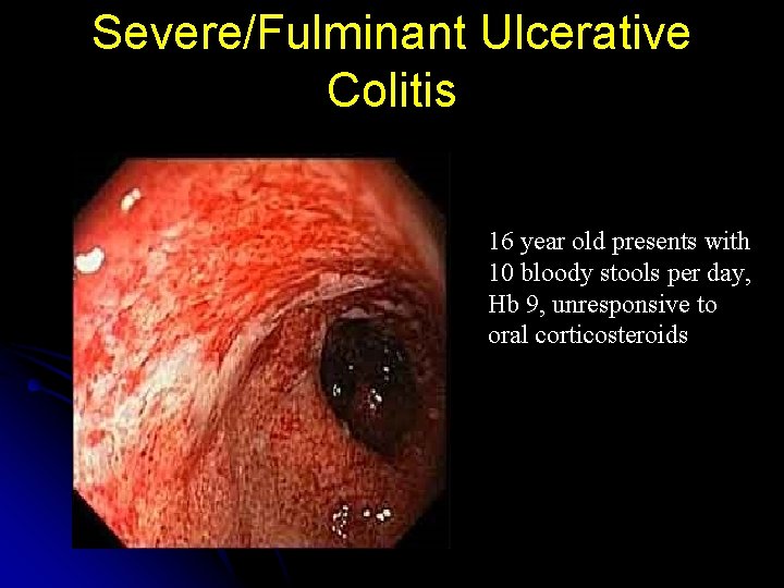 Severe/Fulminant Ulcerative Colitis 16 year old presents with 10 bloody stools per day, Hb