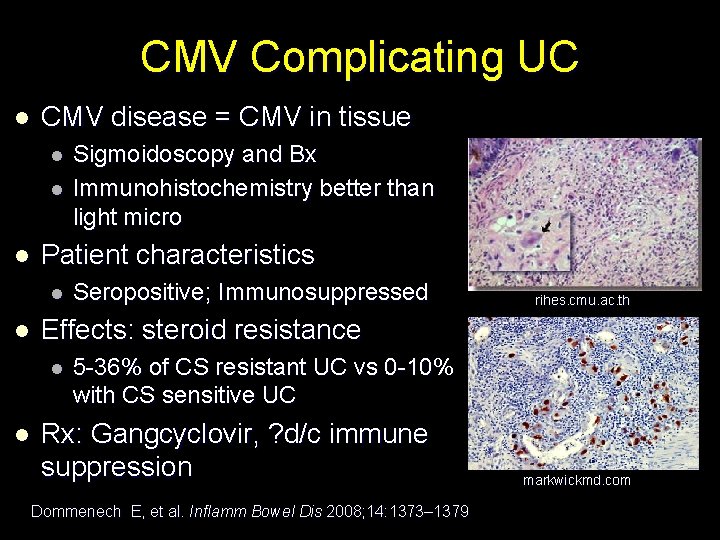 CMV Complicating UC l CMV disease = CMV in tissue l l l Patient