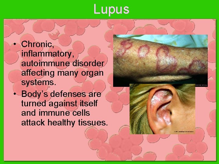 Lupus • Chronic, inflammatory, autoimmune disorder affecting many organ systems. • Body’s defenses are Lupus • Chronic, inflammatory, autoimmune disorder affecting many organ systems. • Body’s defenses are