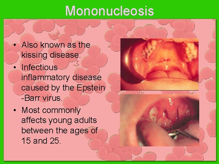 Mononucleosis • Also known as the kissing disease. • Infectious inflammatory disease caused by Mononucleosis • Also known as the kissing disease. • Infectious inflammatory disease caused by