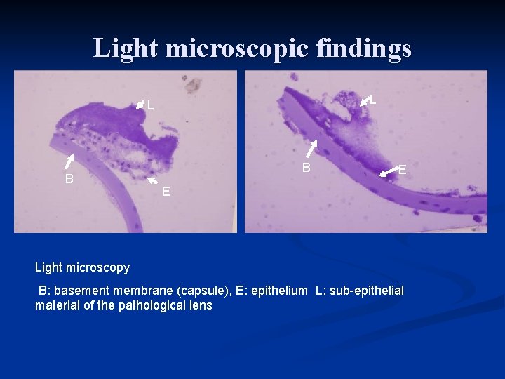 Light microscopic findings L L B B E E Light microscopy B: basement membrane