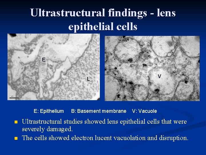 Ultrastructural findings - lens epithelial cells E V L E: Epithelium n n B: