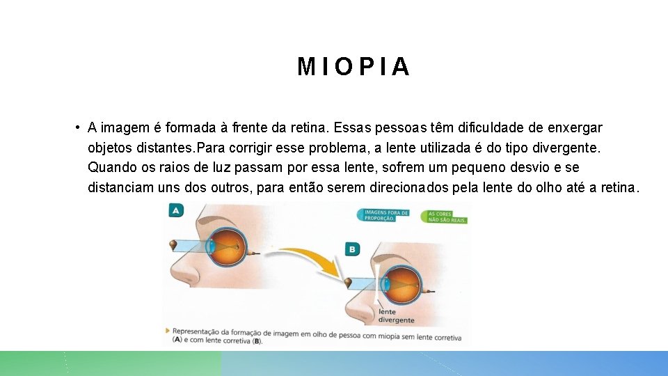 MIOPIA • A imagem é formada à frente da retina. Essas pessoas têm dificuldade