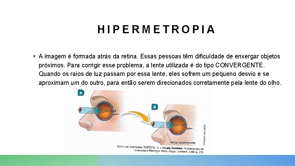 HIPERMETROPIA • A imagem é formada atrás da retina. Essas pessoas têm dificuldade de