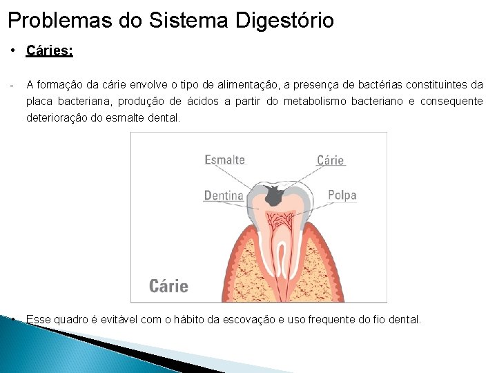 Problemas do Sistema Digestório • Cáries: - A formação da cárie envolve o tipo