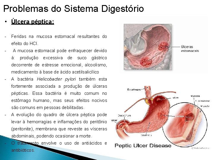 Problemas do Sistema Digestório • Úlcera péptica: - Feridas na mucosa estomacal resultantes do