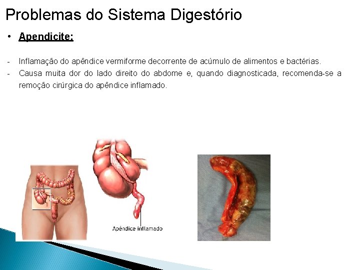 Problemas do Sistema Digestório • Apendicite: - Inflamação do apêndice vermiforme decorrente de acúmulo