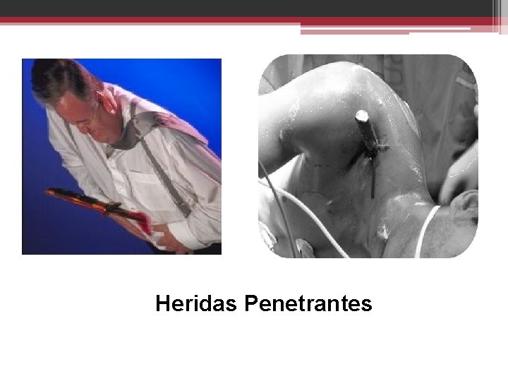 Heridas Penetrantes 