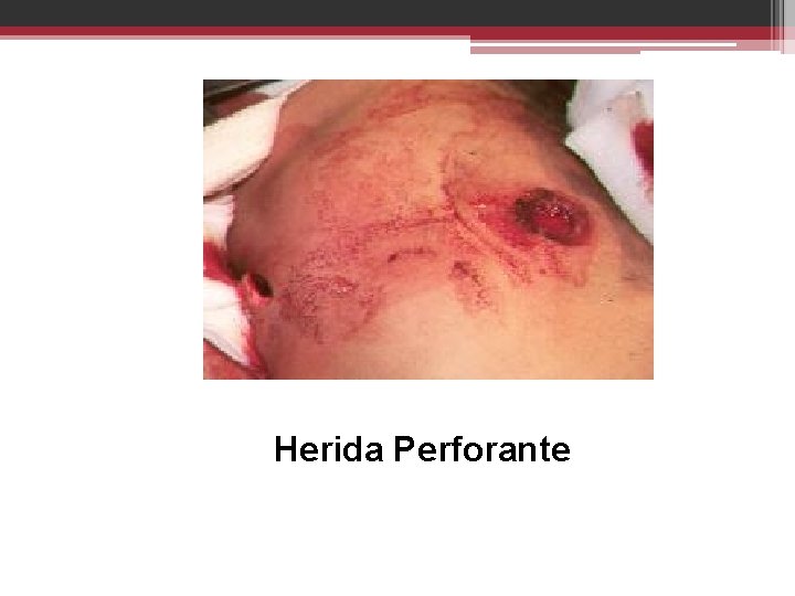 Herida Perforante 