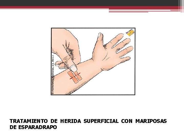 TRATAMIENTO DE HERIDA SUPERFICIAL CON MARIPOSAS DE ESPARADRAPO 