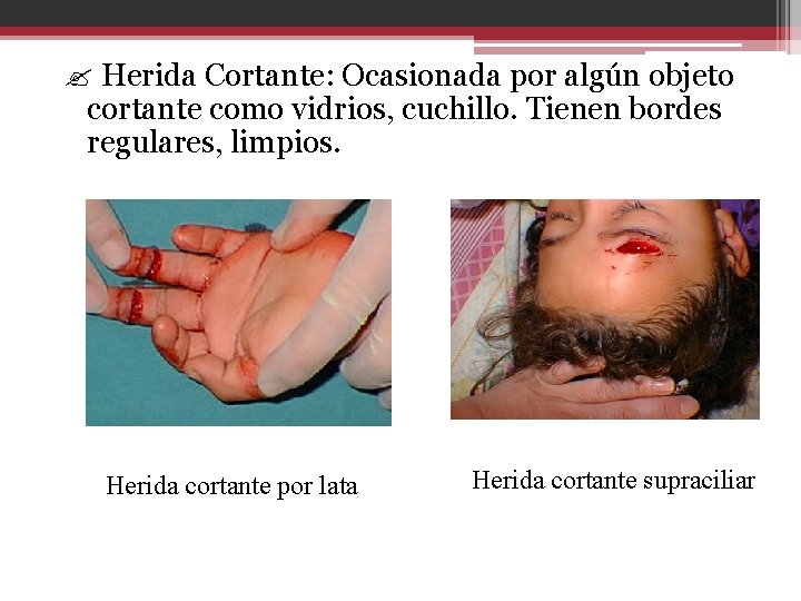 ? Herida Cortante: Ocasionada por algún objeto cortante como vidrios, cuchillo. Tienen bordes regulares,