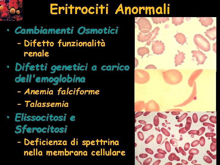 Eritrociti Anormali • Cambiamenti Osmotici – Difetto funzionalità renale • Difetti genetici a carico