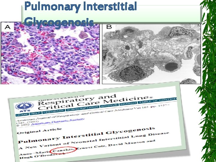 Pulmonary Interstitial Glycogenosis 