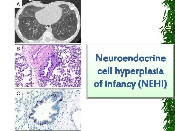 Neuroendocrine cell hyperplasia of infancy (NEHI) 