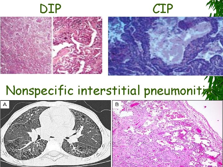 DIP CIP Nonspecific interstitial pneumonitis 