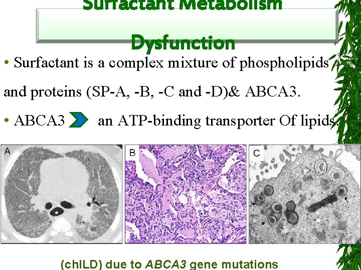 Surfactant Metabolism Dysfunction • Surfactant is a complex mixture of phospholipids and proteins (SP-A,