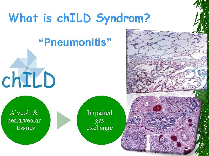 What is ch. ILD Syndrom? “Pneumonitis” Alveoli & perialveolar tissues Impaired gas exchange 