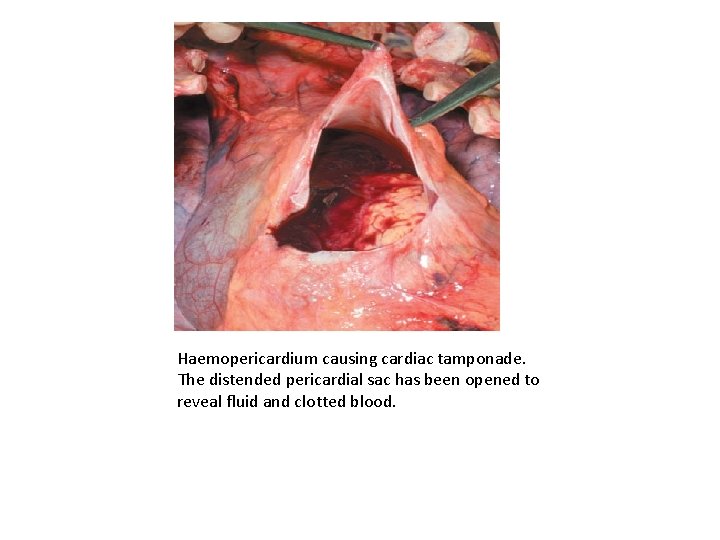 Haemopericardium causing cardiac tamponade. The distended pericardial sac has been opened to reveal fluid