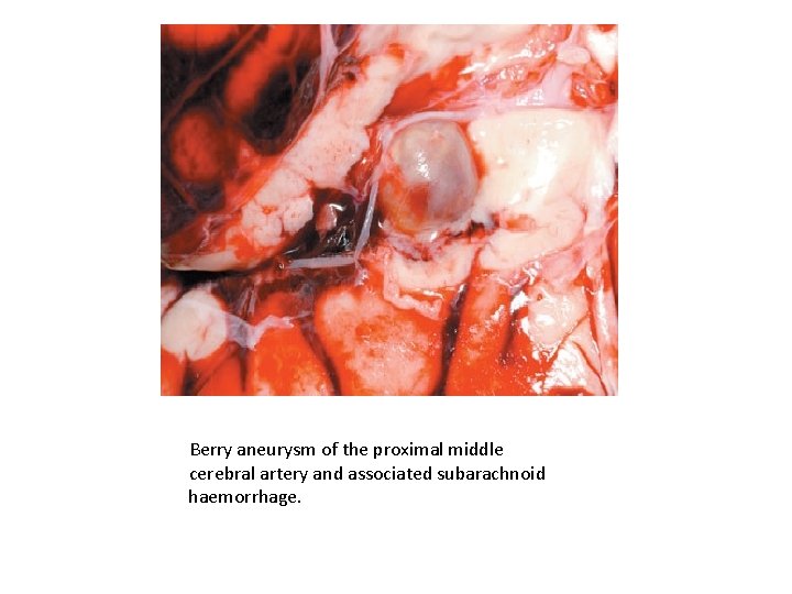 Berry aneurysm of the proximal middle cerebral artery and associated subarachnoid haemorrhage. 