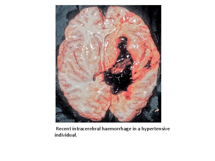 Recent intracerebral haemorrhage in a hypertensive individual. 