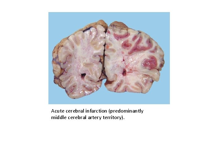 Acute cerebral infarction (predominantly middle cerebral artery territory). 