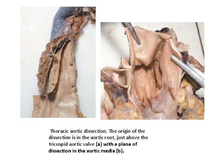 Thoracic aortic dissection. The origin of the dissection is in the aortic root, just