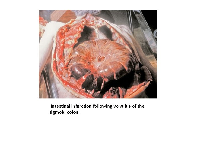Intestinal infarction following volvulus of the sigmoid colon. 