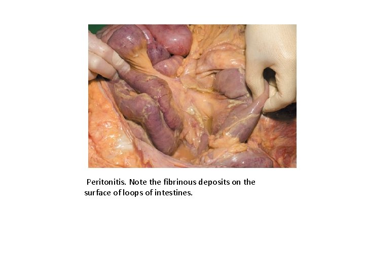 Peritonitis. Note the fibrinous deposits on the surface of loops of intestines. 
