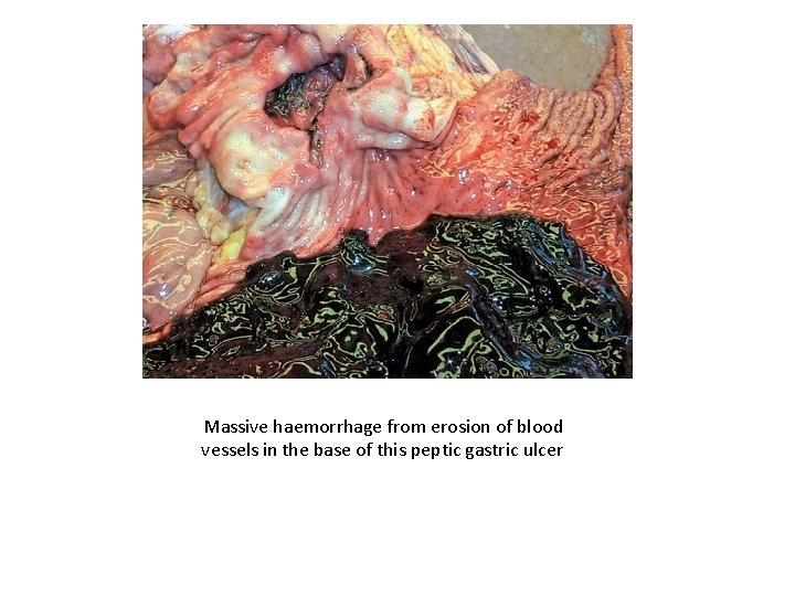 Massive haemorrhage from erosion of blood vessels in the base of this peptic gastric