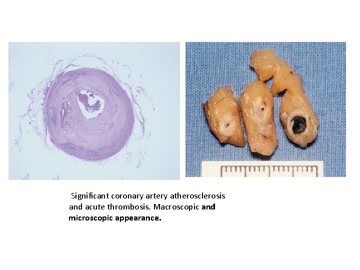 Significant coronary artery atherosclerosis and acute thrombosis. Macroscopic and microscopic appearance. 