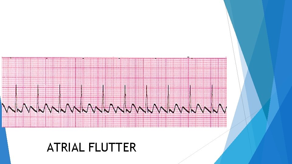 ATRIAL FLUTTER 