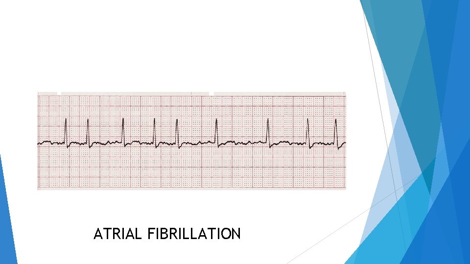 ATRIAL FIBRILLATION 