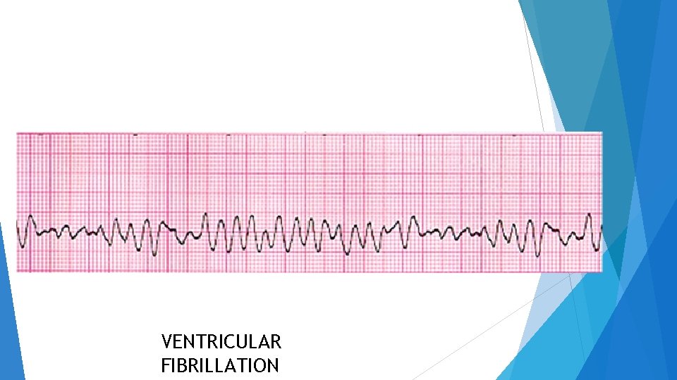 VENTRICULAR FIBRILLATION 
