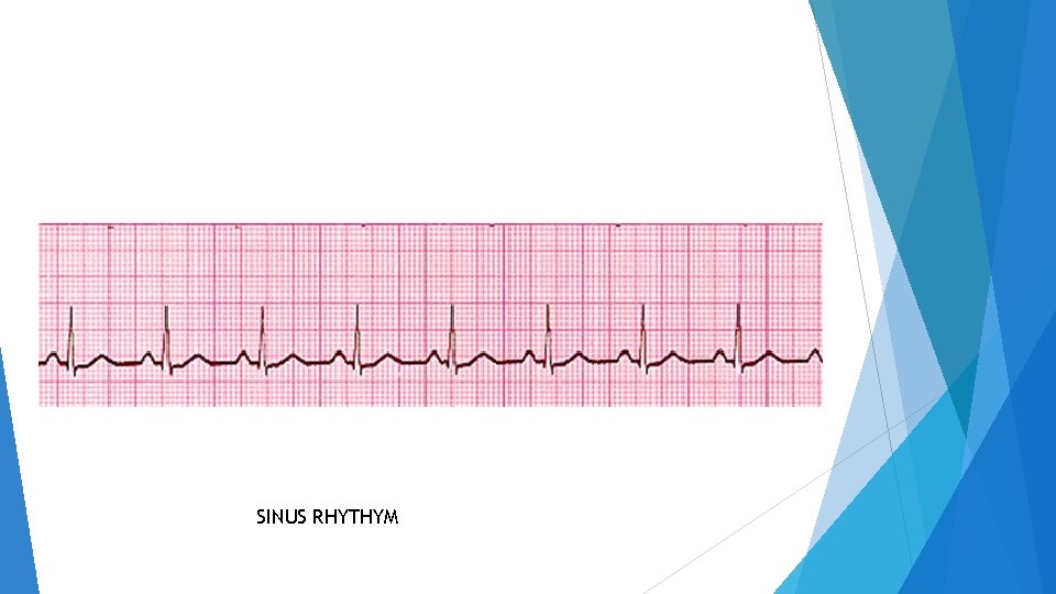 SINUS RHYTHYM 