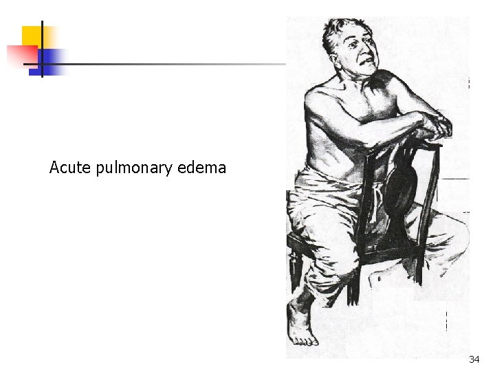 Acute pulmonary edema 34 