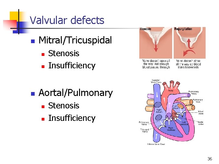 Valvular defects n Mitral/Tricuspidal n n n Stenosis Insufficiency Aortal/Pulmonary n n Stenosis Insufficiency